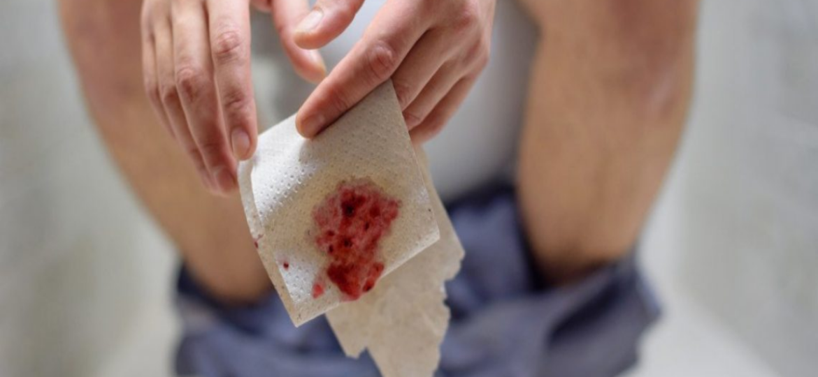 Kada posetiti lekara zbog krvi u stolici
