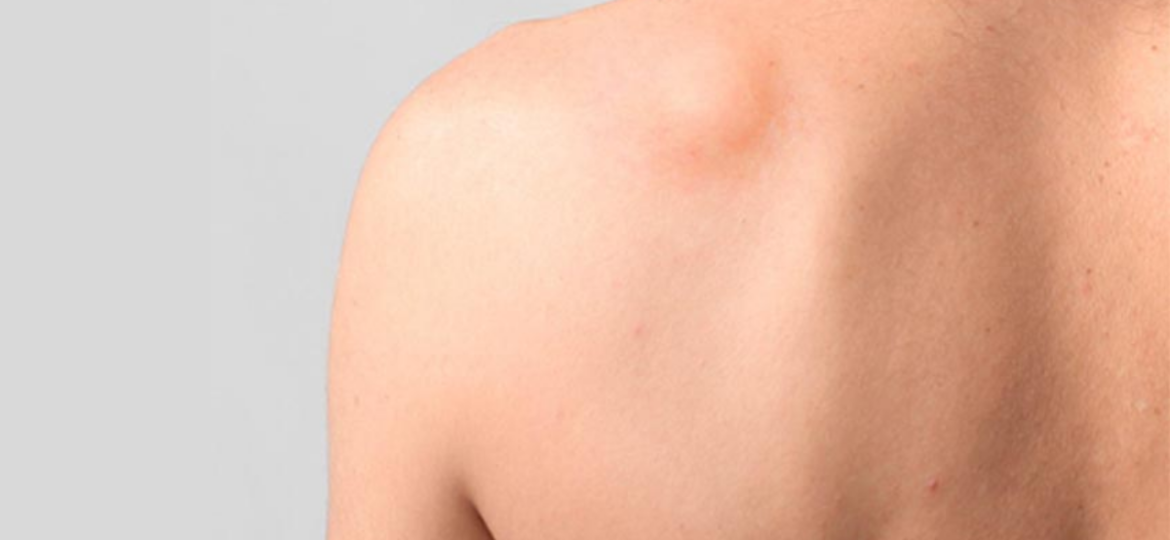 da li je opasno masno tkivo