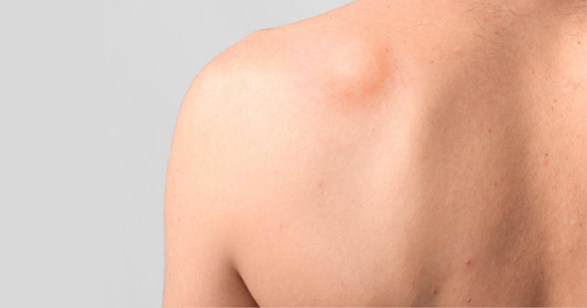 da-li-je-opasno-masno-tkivo-lipom