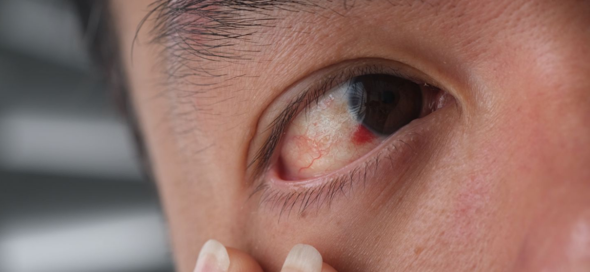 kako izgleda kad pukne kapilar u oku