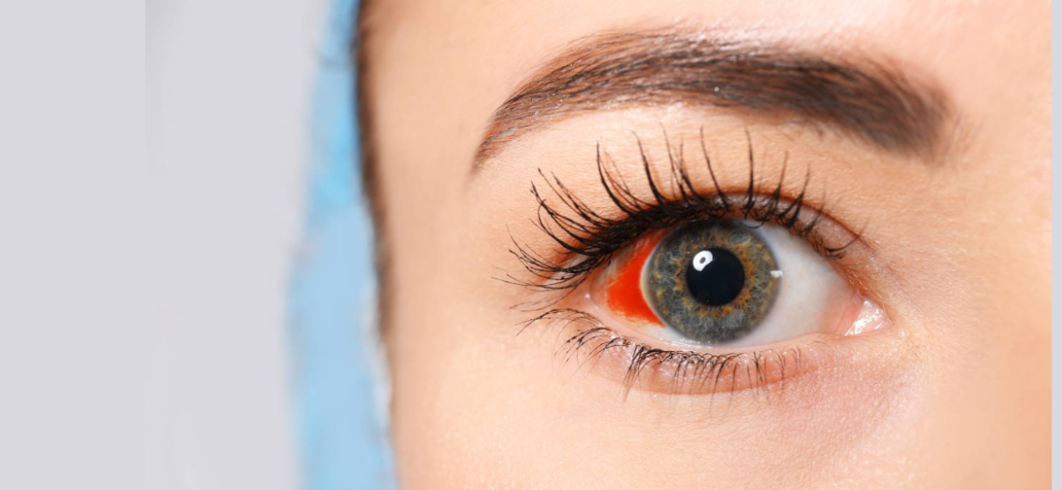 kada se javiti lekaru ybog puknutog kapilara u oku