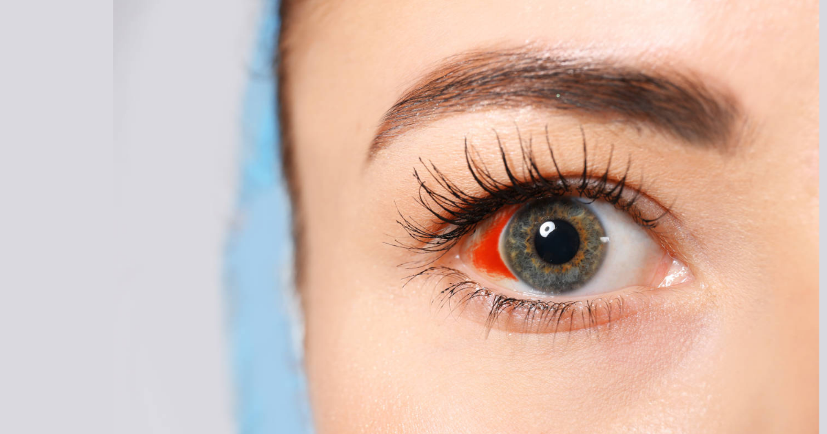 kada-se-javiti-lekaru-zbog-pucanja-kapilara-u-oku