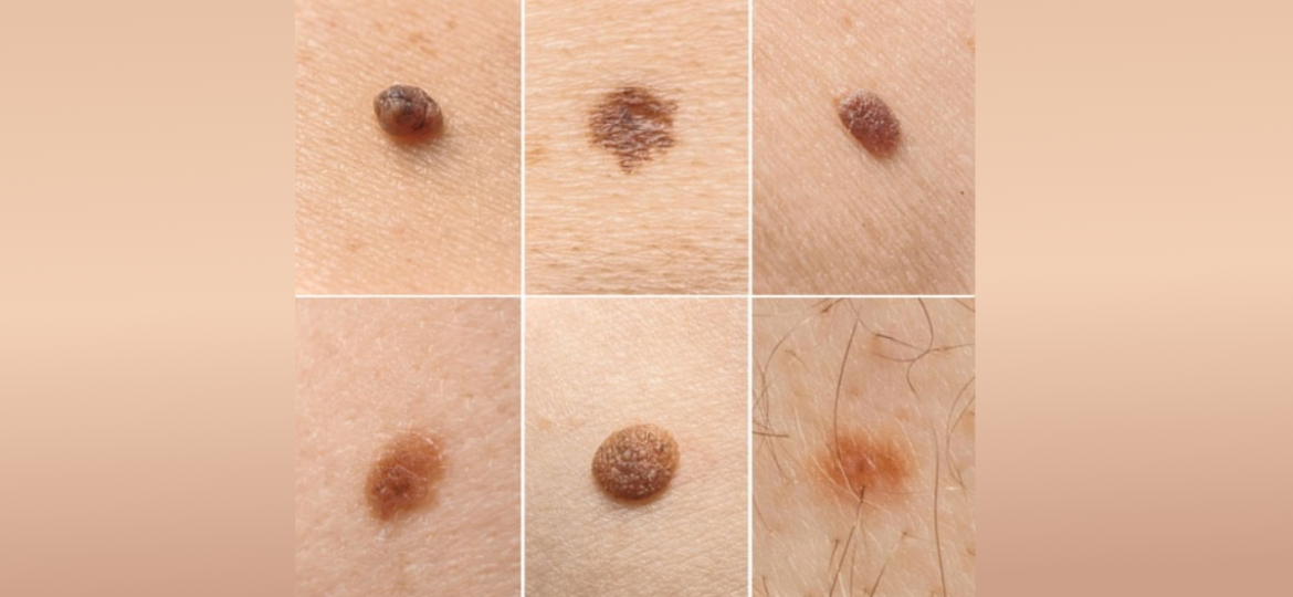 Promene na kozi kada su opasne